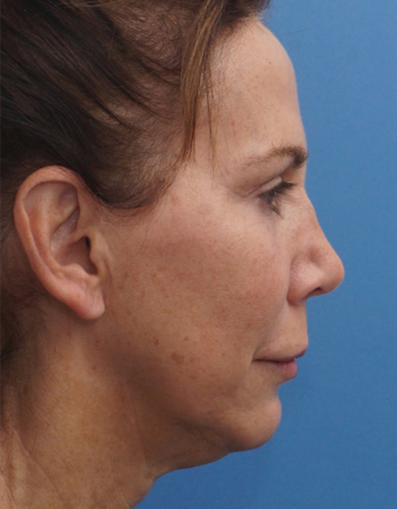 Chin Surgery Before & After Gallery - Patient 229983 - Image 11