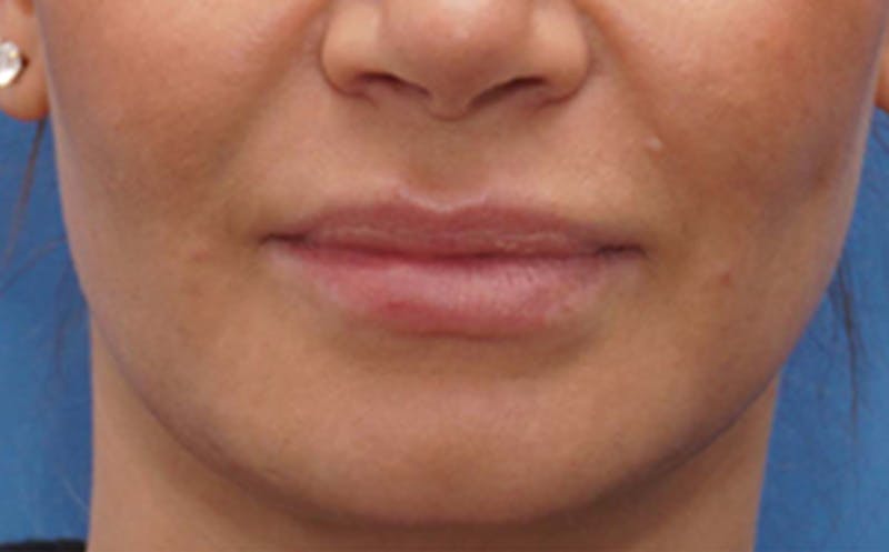 Fillers Before & After Gallery - Patient 290820 - Image 2