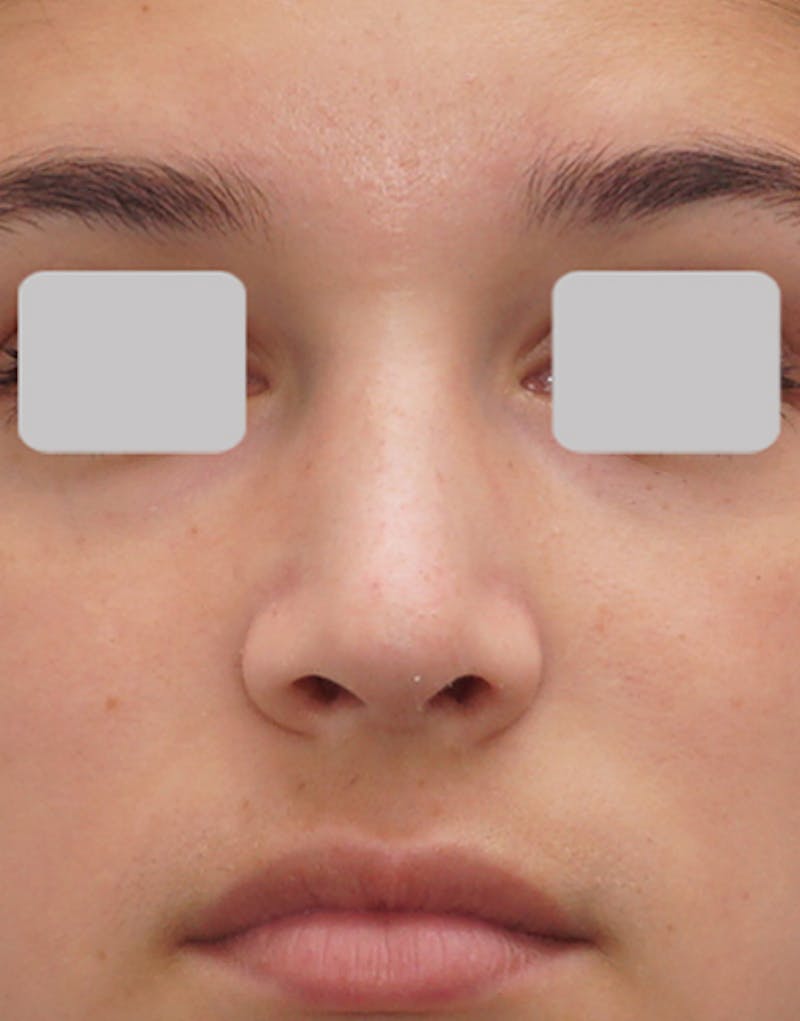 Rhinoplasty Before & After Gallery - Patient 125769 - Image 6