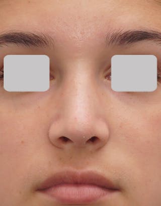 Rhinoplasty Before & After Gallery - Patient 215853 - Image 6