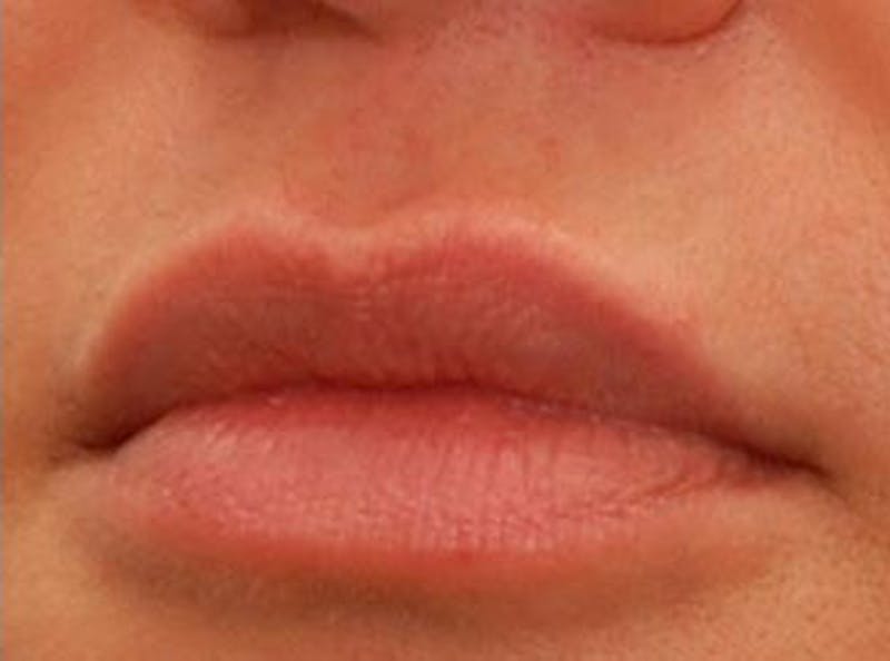 Lip Fillers Before & After Gallery - Patient 132953 - Image 4