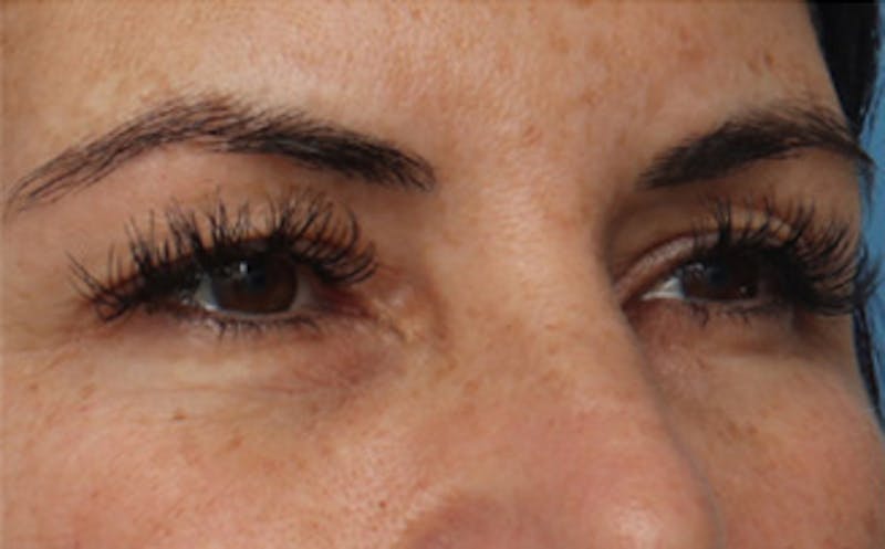 Patient Av0siIsIQTO-ws4VYb2EbA - Eyelid Surgery Before & After Photos