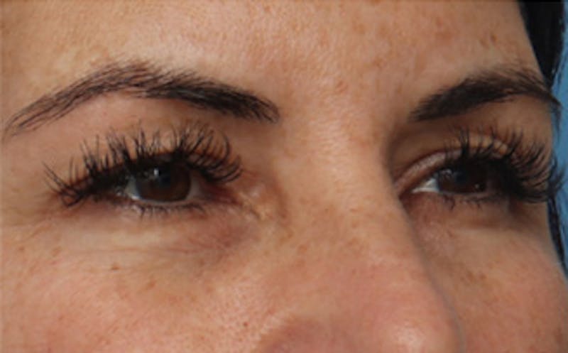 Eyelid Surgery Before & After Gallery - Patient 298444 - Image 1