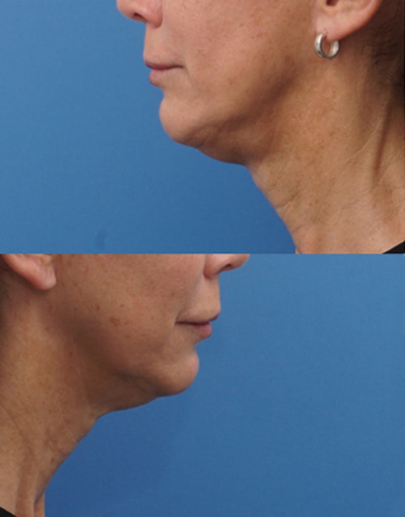 FaceTite Before & After Gallery - Patient 372280 - Image 3
