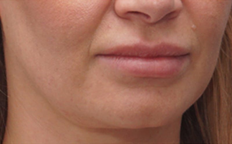 Fillers Before & After Gallery - Patient 290820 - Image 3