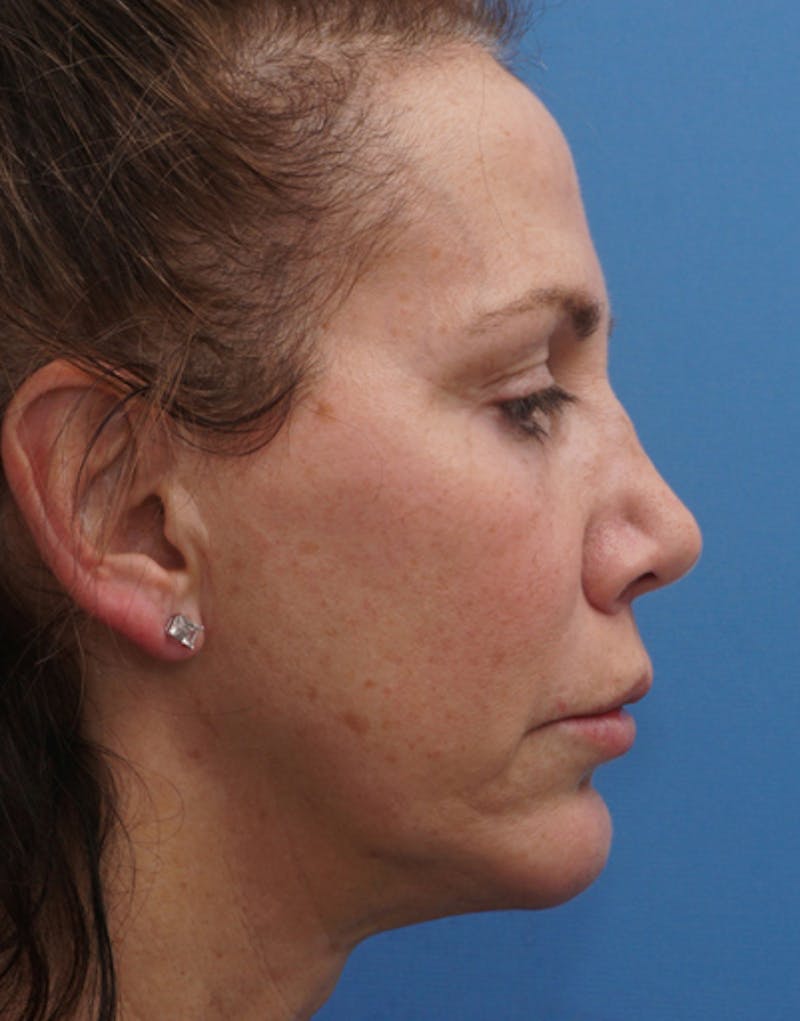 Chin Surgery Before & After Gallery - Patient 229983 - Image 12