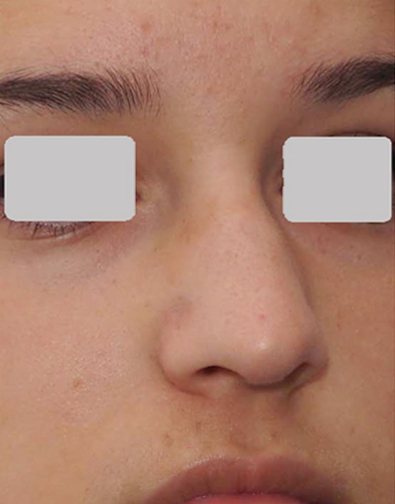Rhinoplasty Before & After Gallery - Patient 125769 - Image 7
