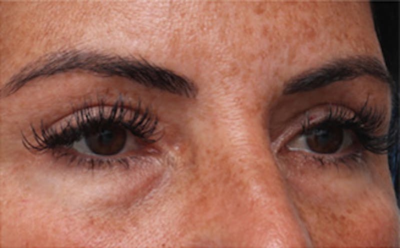 Eyelid Surgery Before & After Gallery - Patient 298444 - Image 2