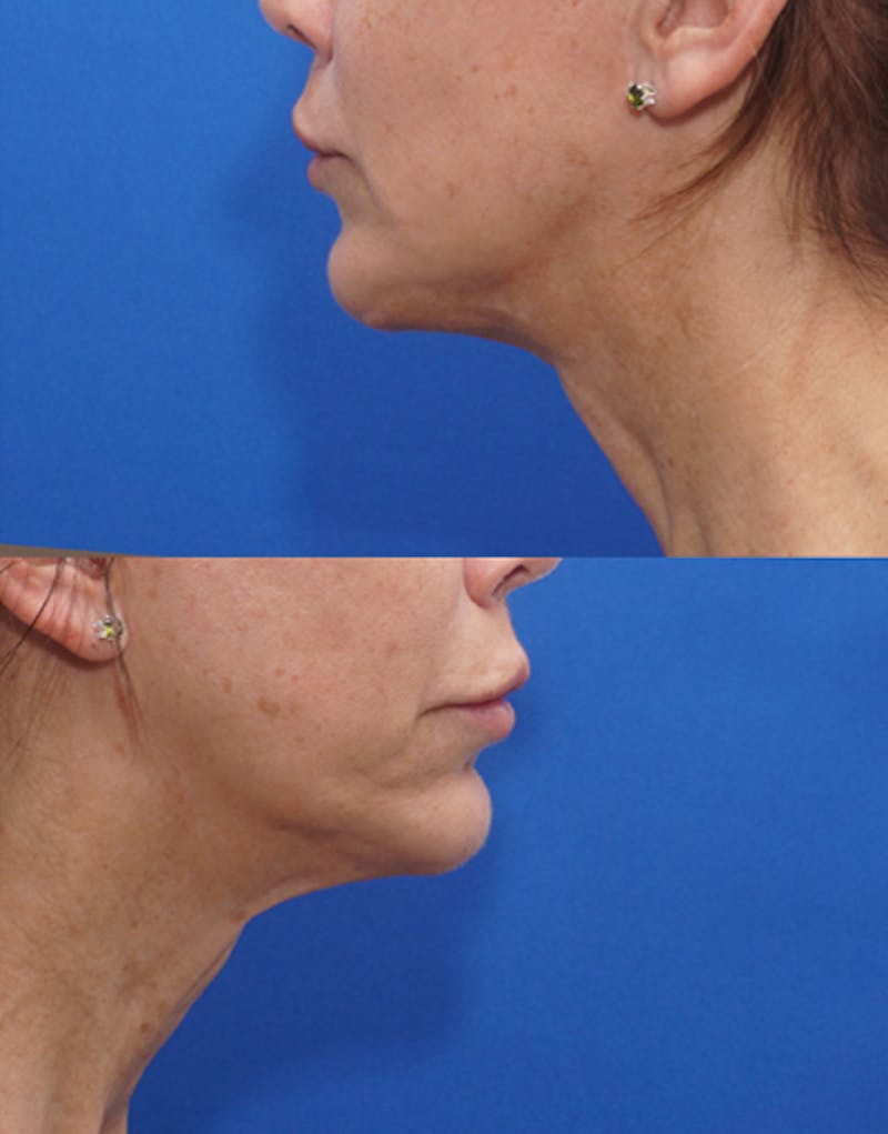 FaceTite Before & After Gallery - Patient 372280 - Image 4