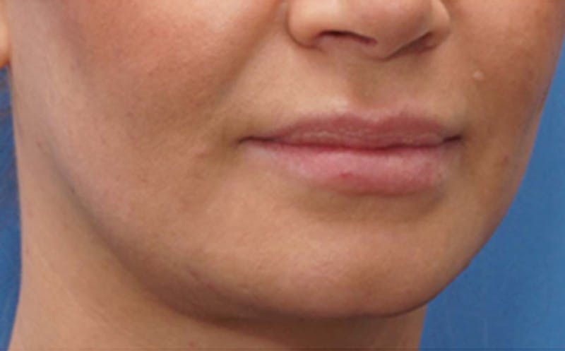 Fillers Before & After Gallery - Patient 290820 - Image 4