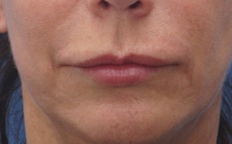Chin Surgery Before & After Gallery - Patient 229983 - Image 13