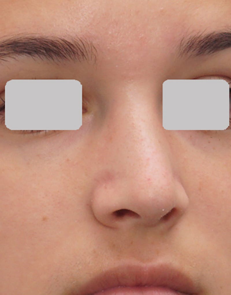 Rhinoplasty Before & After Gallery - Patient 125769 - Image 8