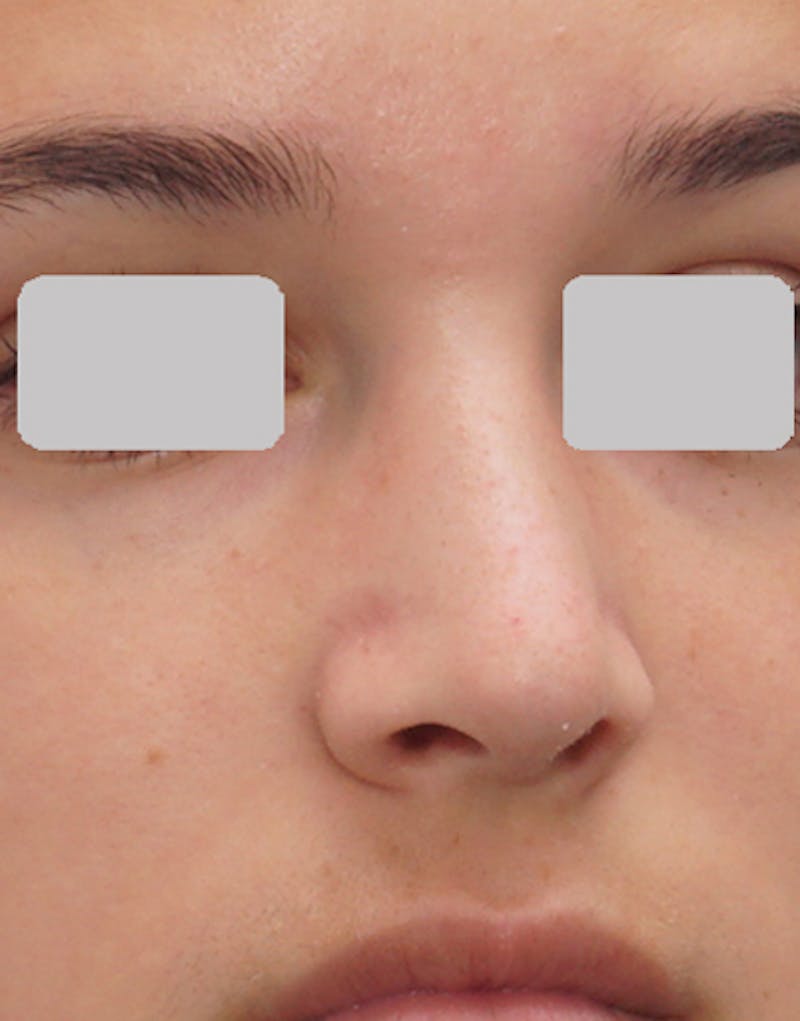 Rhinoplasty  Before & After Gallery - Patient 215853 - Image 8