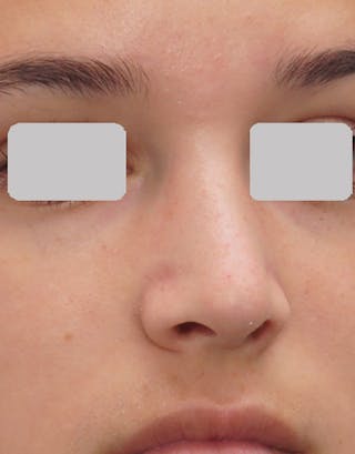 Rhinoplasty Before & After Gallery - Patient 215853 - Image 8