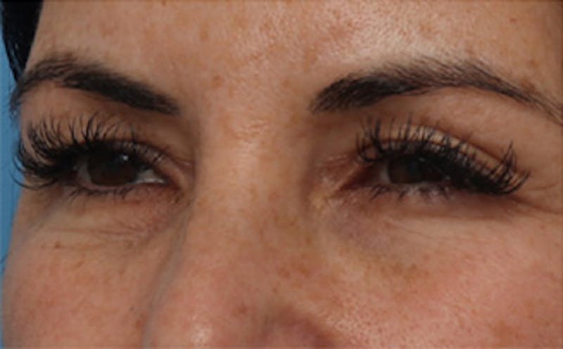 Eyelid Surgery Before & After Gallery - Patient 298444 - Image 7