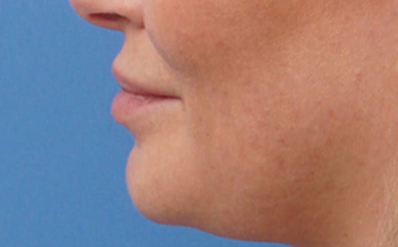 Fillers Before & After Gallery - Patient 290820 - Image 5