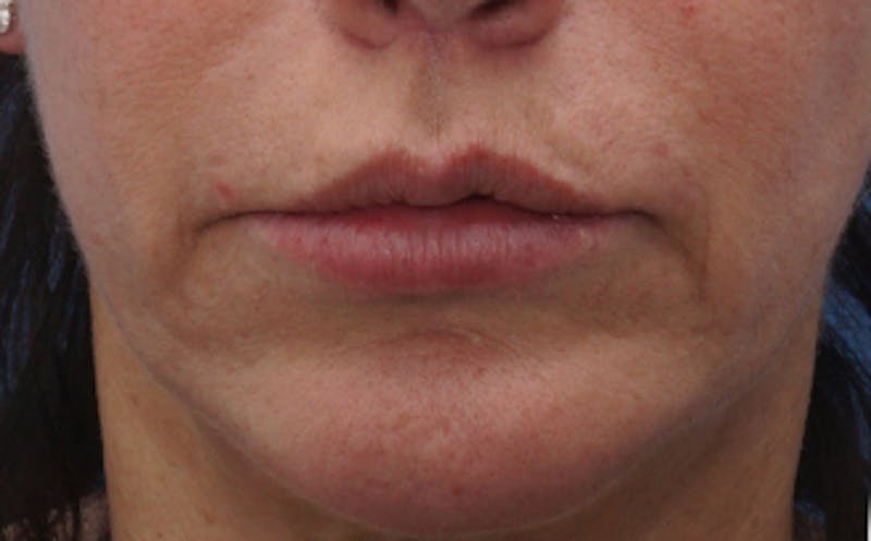 Chin Surgery Before & After Gallery - Patient 229983 - Image 14