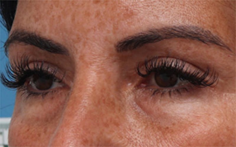 Eyelid Surgery Before & After Gallery - Patient 298444 - Image 8