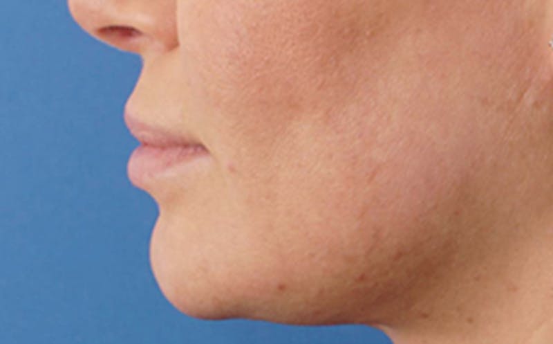 Fillers Before & After Gallery - Patient 290820 - Image 6