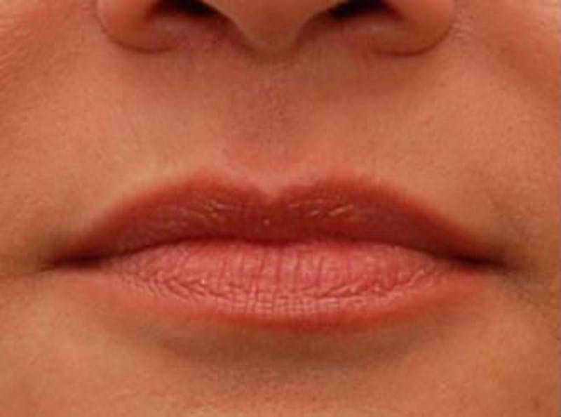 Lip Fillers Before & After Gallery - Patient 421628 - Image 1