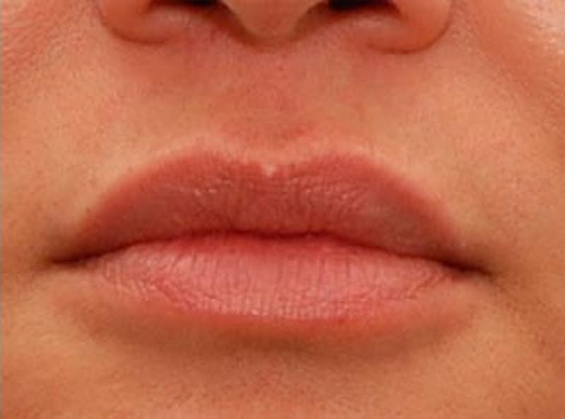 Lip Fillers Before & After Gallery - Patient 421628 - Image 2