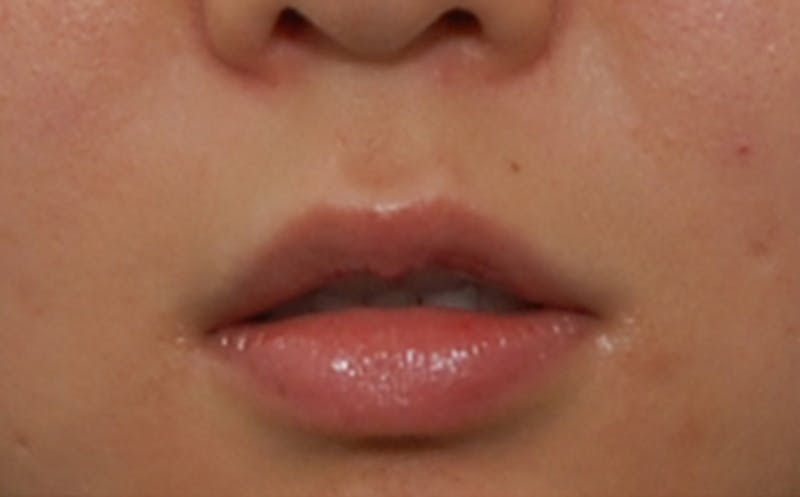 Fillers Before & After Gallery - Patient 231211 - Image 1
