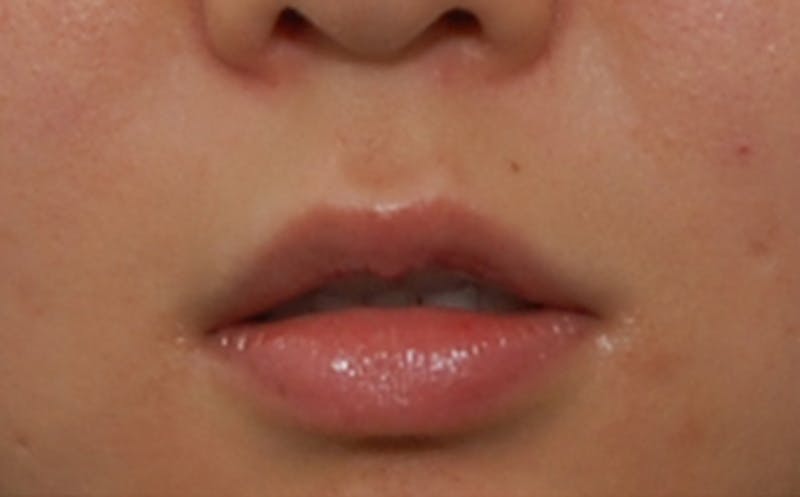 Patient epZ9eeF4TBOUG3L3-wGhSg - Lip Fillers Before & After Photos