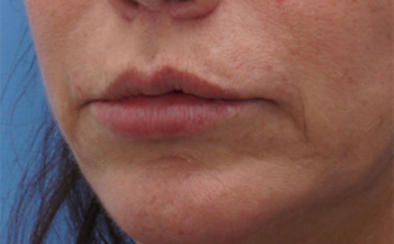 Chin Surgery Before & After Gallery - Patient 229983 - Image 16
