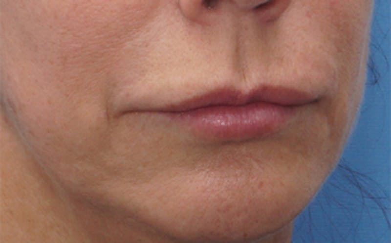 Chin Surgery Before & After Gallery - Patient 229983 - Image 17