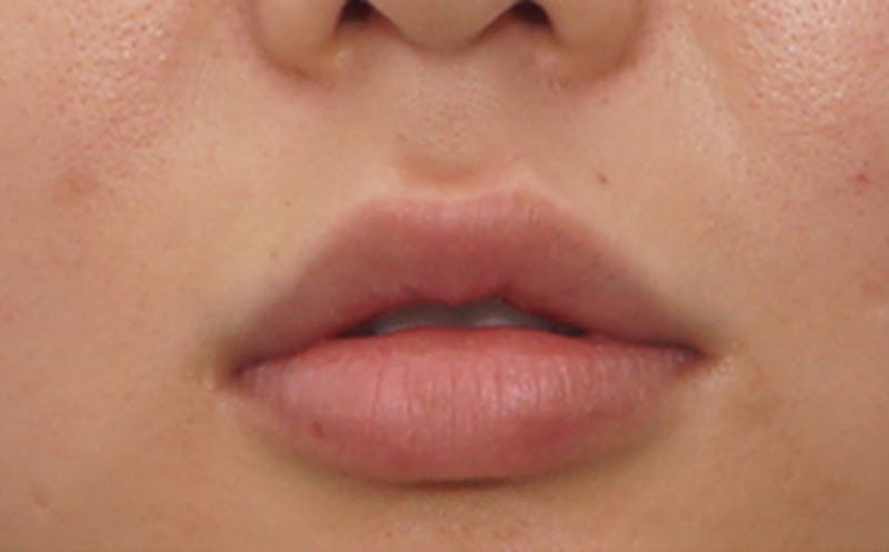Fillers Before & After Gallery - Patient 231211 - Image 2