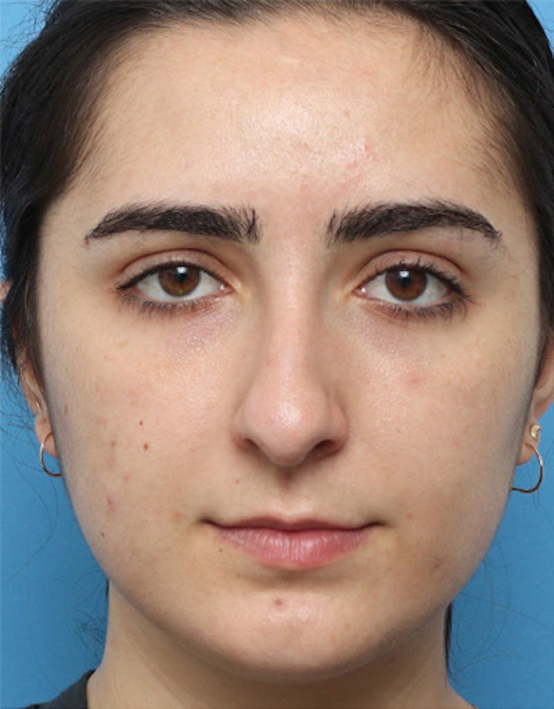 Rhinoplasty Before & After Gallery - Patient 136889 - Image 1