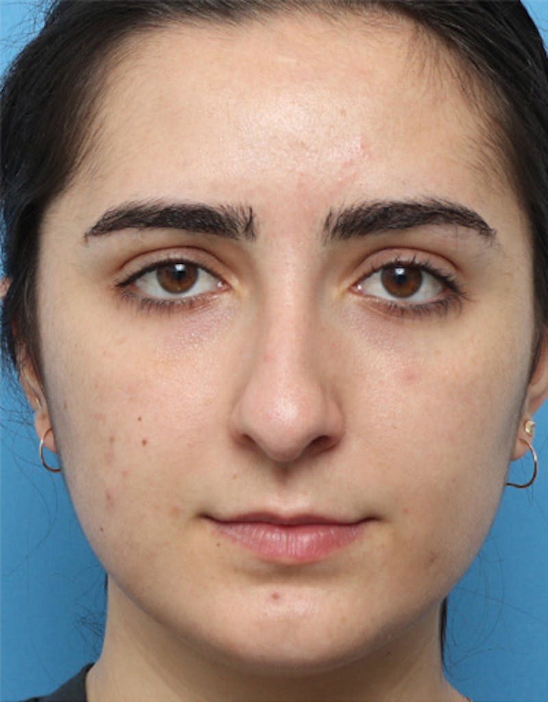 Patient QdYplPGqRm-HybQOUyuEAg - Rhinoplasty Before & After Photos