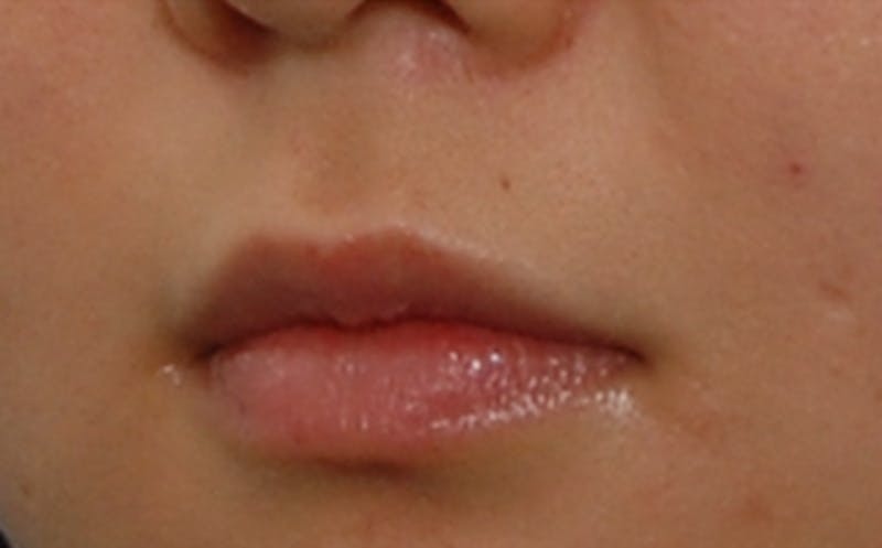 Fillers Before & After Gallery - Patient 231211 - Image 3
