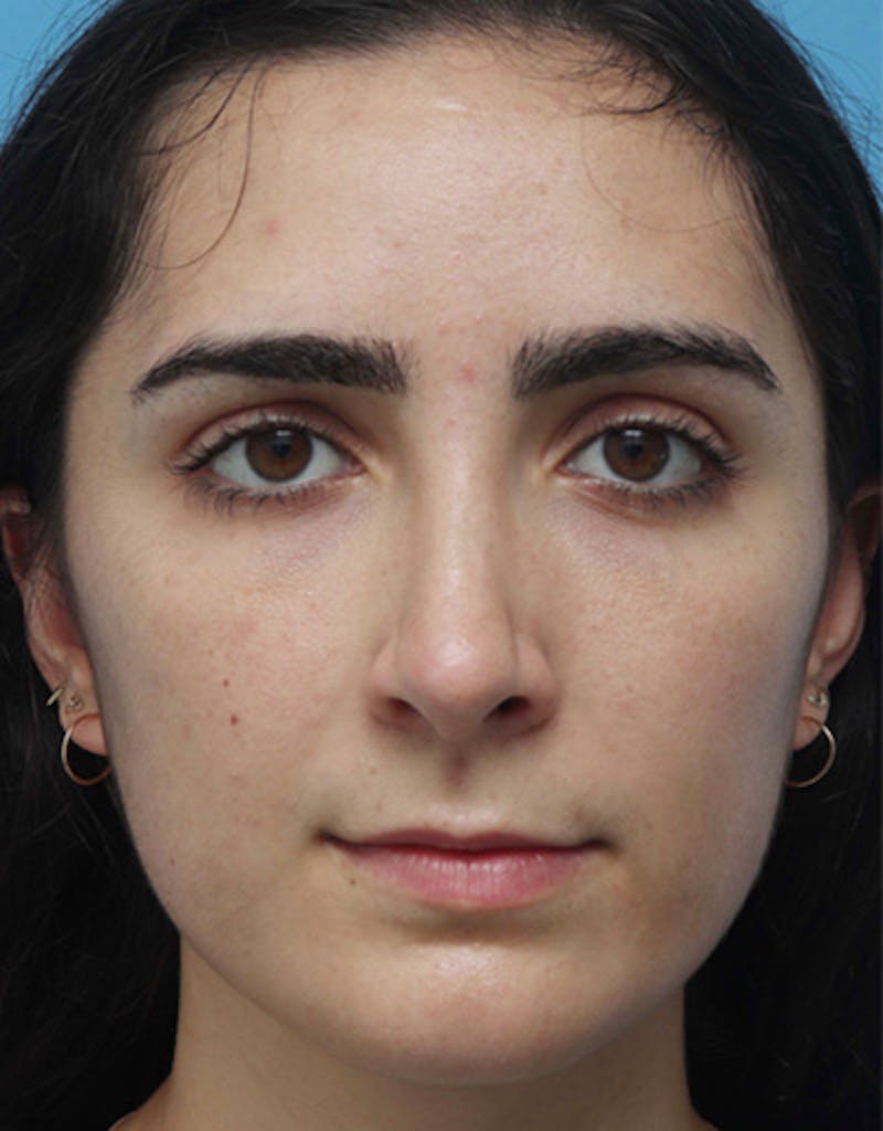 Rhinoplasty Before & After Gallery - Patient 136889 - Image 2
