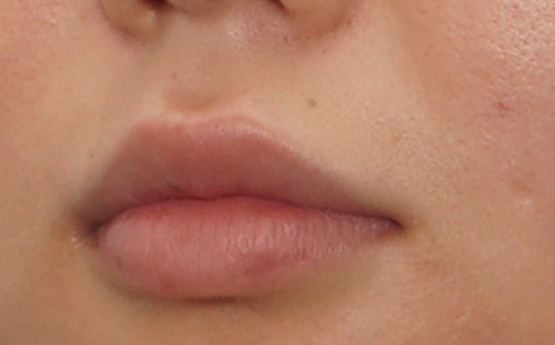Fillers Before & After Gallery - Patient 231211 - Image 4