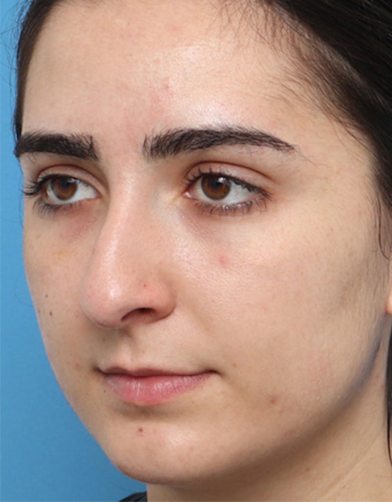 Rhinoplasty Before & After Gallery - Patient 136889 - Image 3