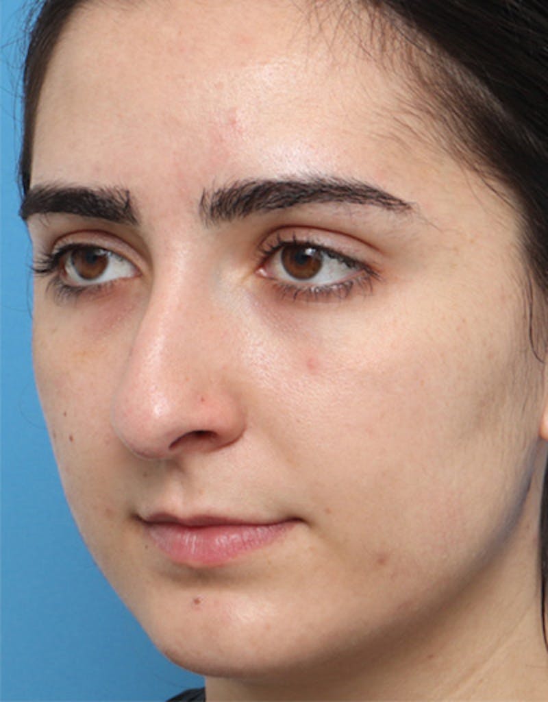 Rhinoplasty  Before & After Gallery - Patient 286977 - Image 3
