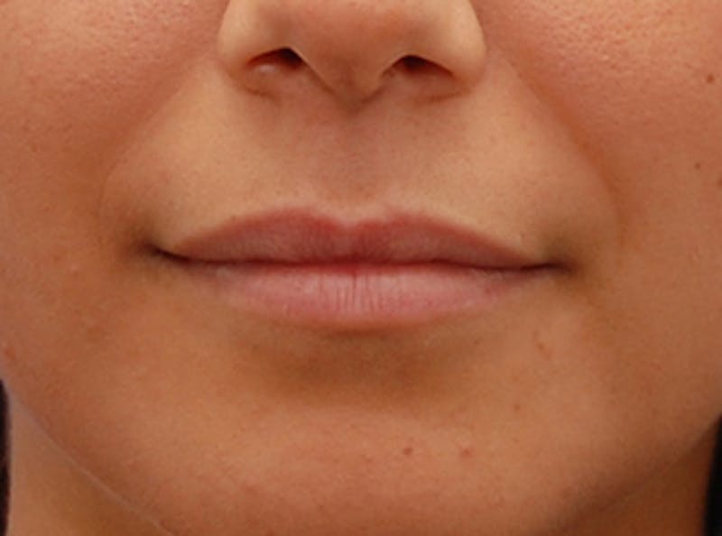 Patient T77NrYlqT6KevrML6i21QA - Lip Fillers Before & After Photos