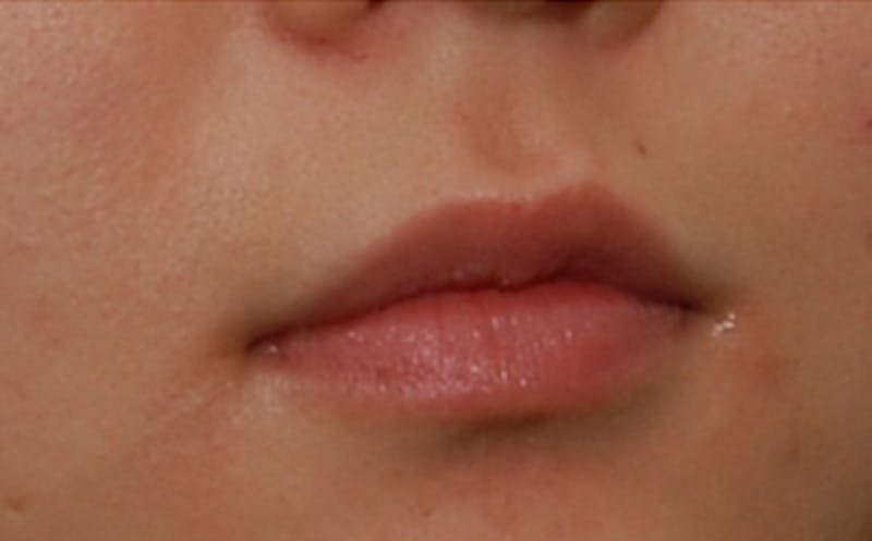 Fillers Before & After Gallery - Patient 231211 - Image 5