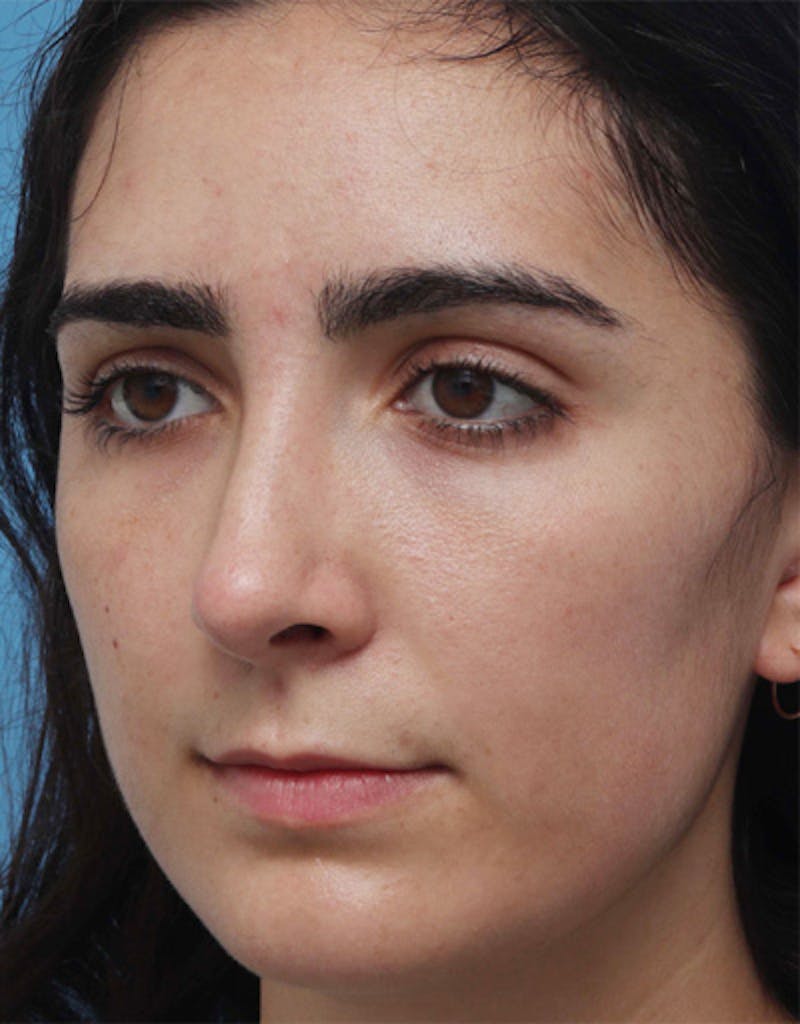 Rhinoplasty Before & After Gallery - Patient 136889 - Image 4