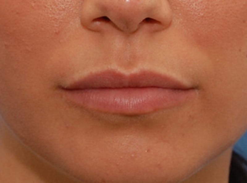Lip Fillers Before & After Gallery - Patient 135275 - Image 2