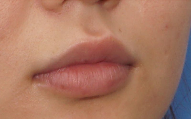 Fillers Before & After Gallery - Patient 231211 - Image 6