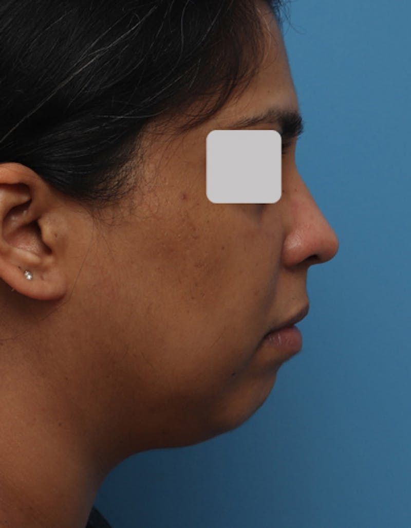 Chin Surgery Before & After Gallery - Patient 240093 - Image 1