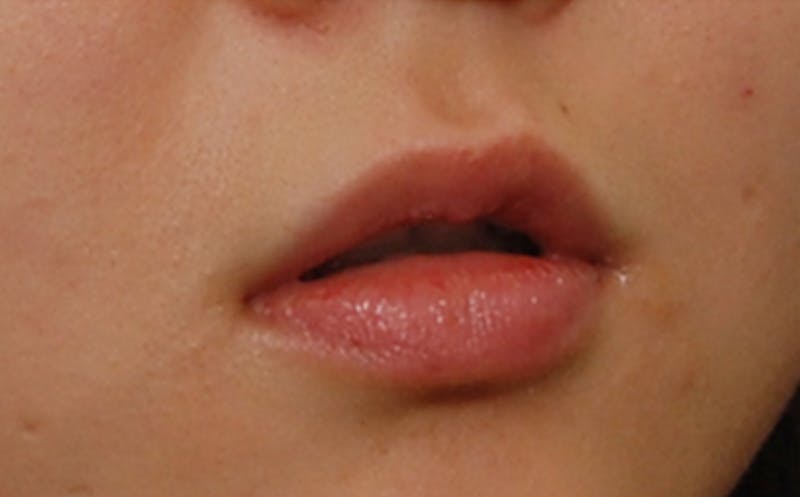 Fillers Before & After Gallery - Patient 231211 - Image 7