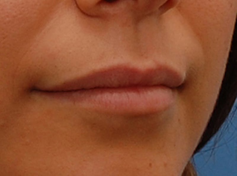 Lip Fillers Before & After Gallery - Patient 135275 - Image 3