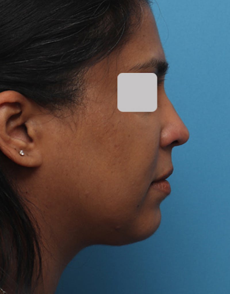 Chin Surgery Before & After Gallery - Patient 240093 - Image 2