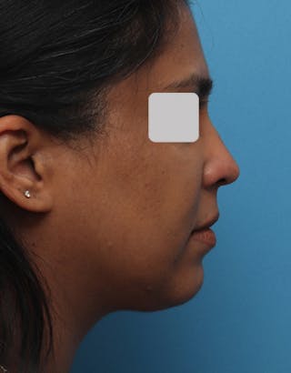 Chin Surgery Before & After Gallery - Patient 240093 - Image 2
