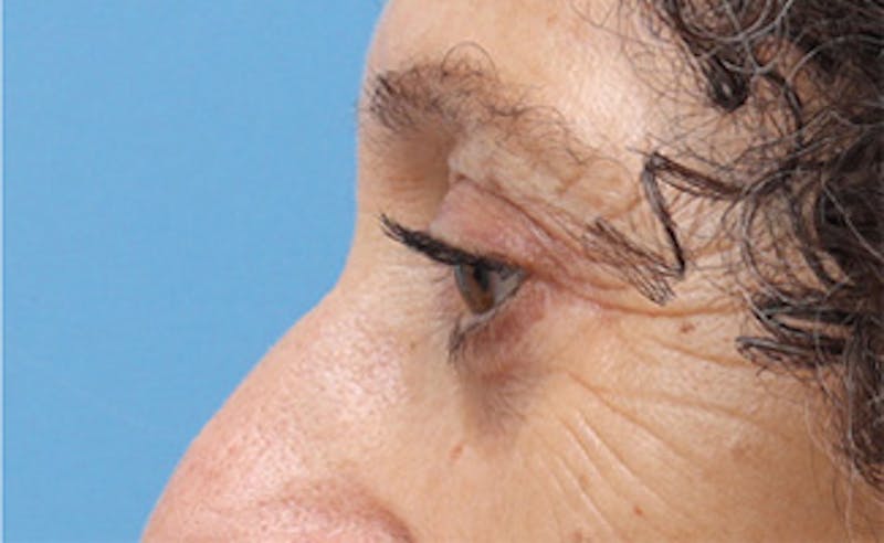 Eyelid Surgery Before & After Gallery - Patient 255441 - Image 8