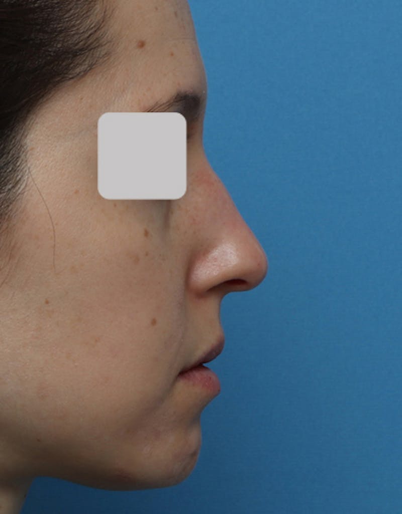 Patient MwQsJIK0QTKWzb1hycM3sQ - Rhinoplasty Before & After Photos