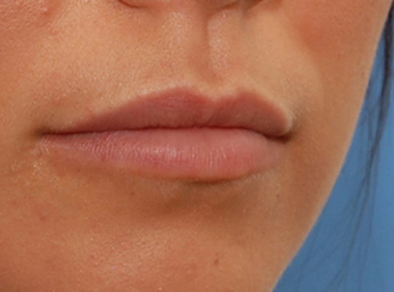 Lip Fillers Before & After Gallery - Patient 135275 - Image 4